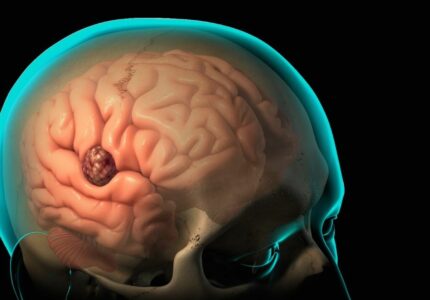 Признаки опухоли головного мозга